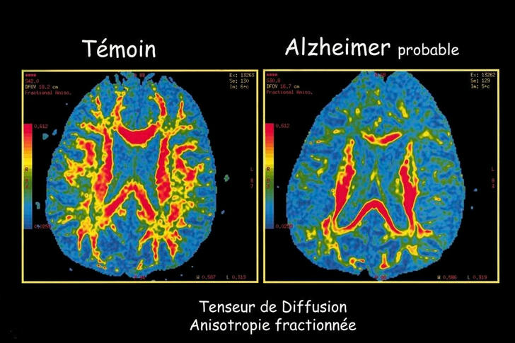 Reduce the Risk of Dementia