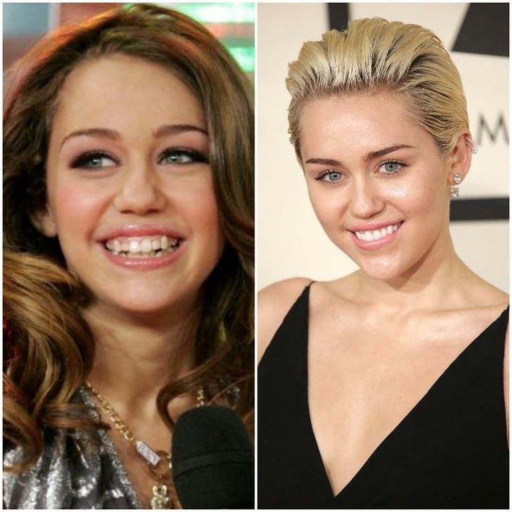 Celebs Who Had The Most Expensive Dental Care For Perfect Teeth